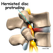 Herniated_Disc herniated disc