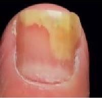 Ridges in Fingernails