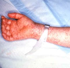 Rocky_mountain_spotted_fever Image from Wikipedia public domain