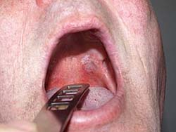 White Leukoplakia Tongue