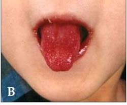Red Strawberry Tongue