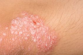 #1 Natural Psoriasis Cure ... Flushing?