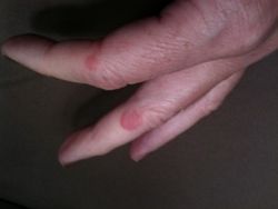 How to Clear Up Hives Naturally