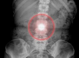 Degenerative Disc Disease: Causes, Symptoms and Treatments