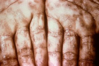 1280px-Secondary_Syphilis_on_palms_CDC_6809_lores.rsh 1280px-Secondary_Syphilis_on_palms_CDC_6809_lores.rsh