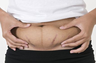 h eliminate stretch marks