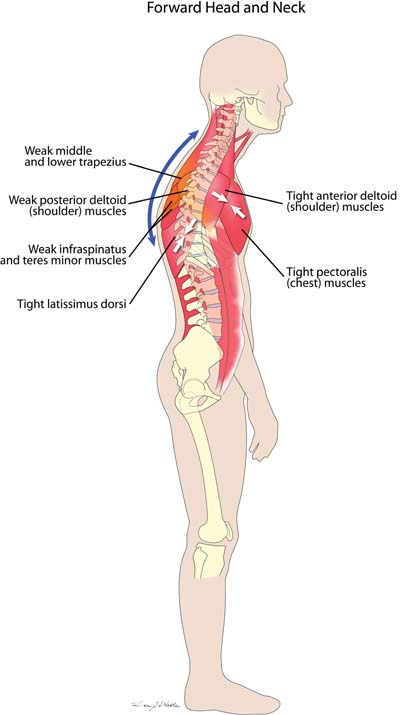 Forward Head and Neck Muscle Imbalance