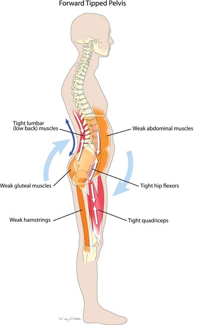 Forward Tipped Pelvis Muscle Imbalance