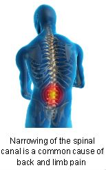 Treatment for Spinal Stenosis