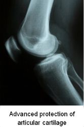 Glucosamine and Chondroitin: Miracle Joint Cure?