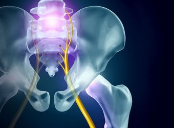 How Long Does Sciatica Last?