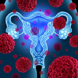 Do Ovarian Cysts Cause Back Pain?