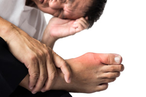 6 Natural Treatments for Gout