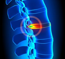 10 Natural Herniated Disc Treatments That Don't Require Surgery