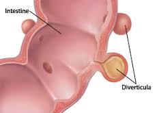 diverticulitis