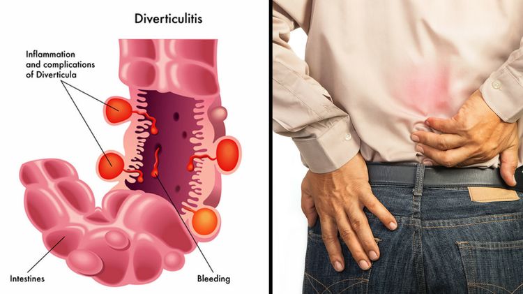 diverticulitis low back pain