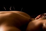 back acupuncture therapy