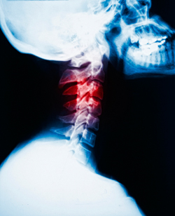 neck disc pain