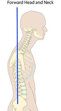 Forward Head Posture Dysfunction
