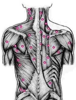 Upper Back Trigger Points