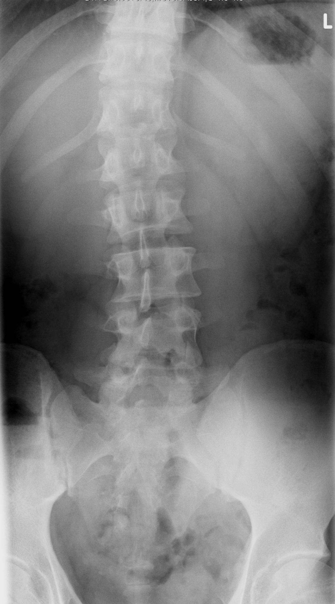 What Causes Scoliosis 