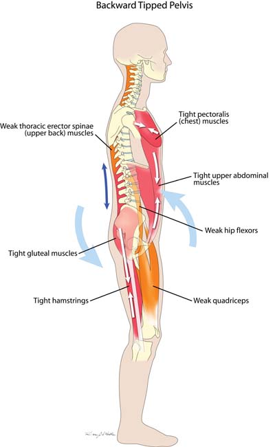 Backward Tipped Pelvis Muscle Imbalance