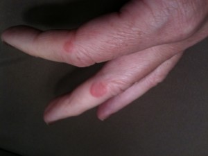 hives on finger