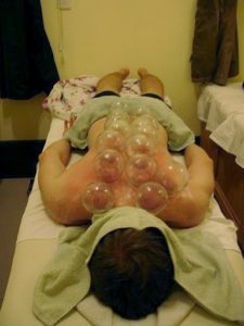 Fire Cupping