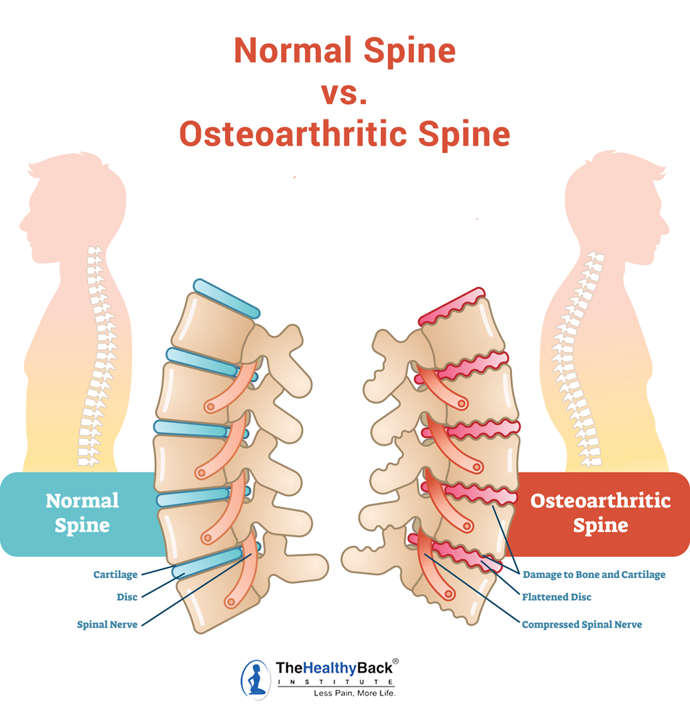 Spinal Arthritis Causes, Symptoms and Treatments