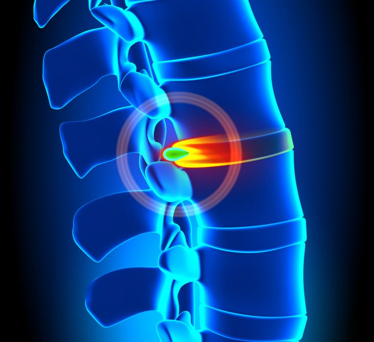 Herniated Disc Exercises Everything You Need to Know